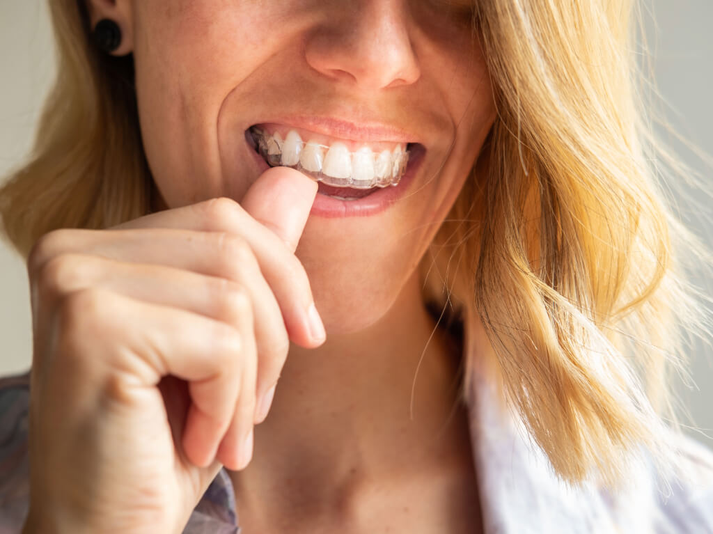 Blond kvinna som sätter in en aligners